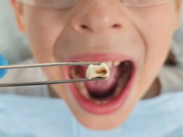 Best Broken or Cracked Tooth Emergency Dentist in North Scituate, MA